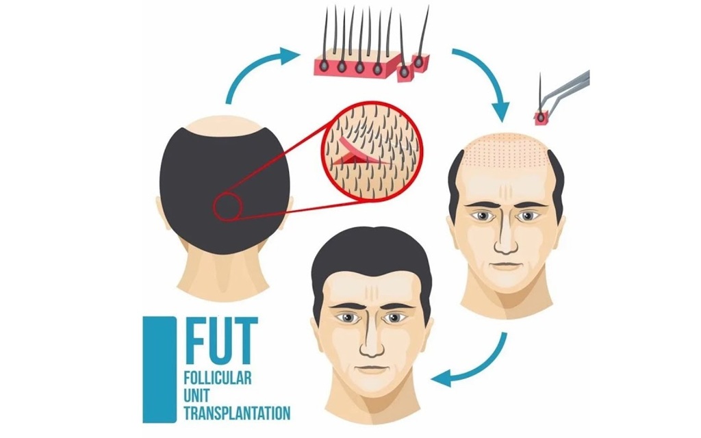 FUT Hair transplant in islamabad