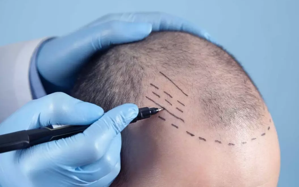 Fue Hair transplant in Islamabad