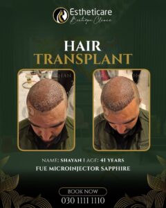 Hair Transplant