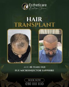 Hair Transplant Before & After