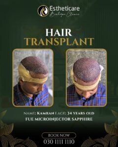 Hair Transplant Islamabad
