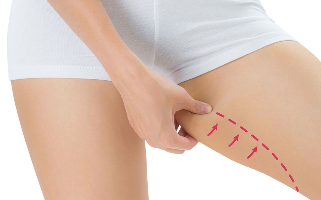 thigh liposuction in Islamabad