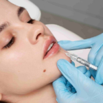 Can Lip Fillers Improve Your Smile