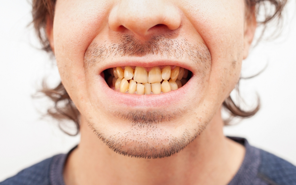 Can Teeth Whitening Help with Yellow Teeth?