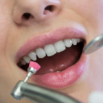 How Much Does Teeth Whitening Cost