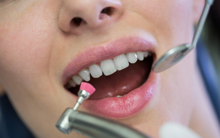 How Much Does Teeth Whitening Cost