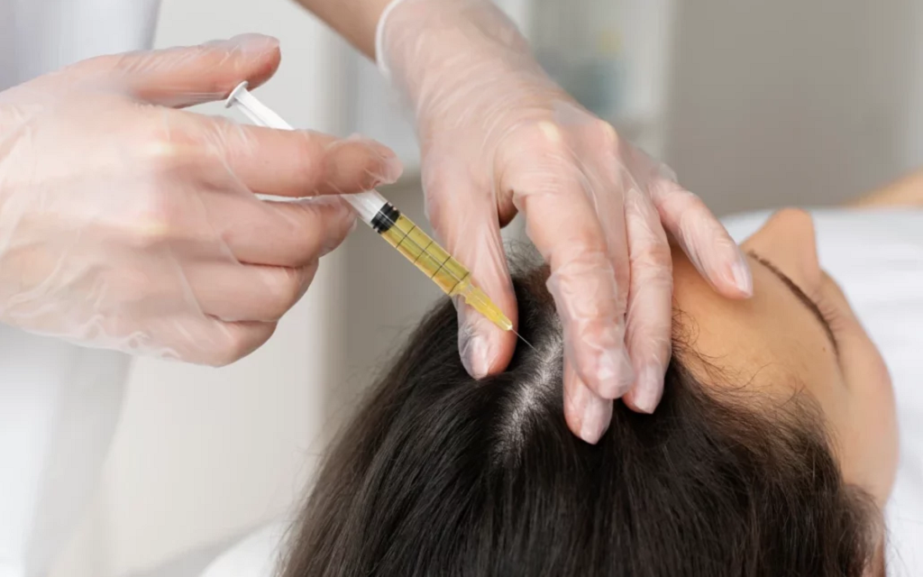 PRP Treatment for Hair Loss in Islamabad