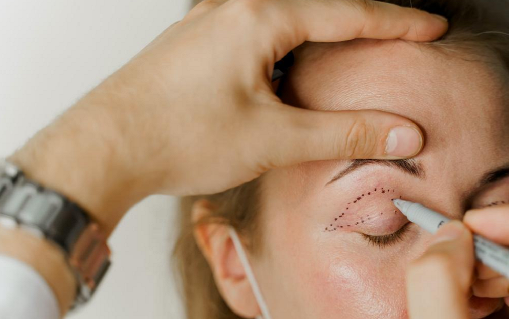 Eyelid Surgery (Blepharoplasty) in Islamabad