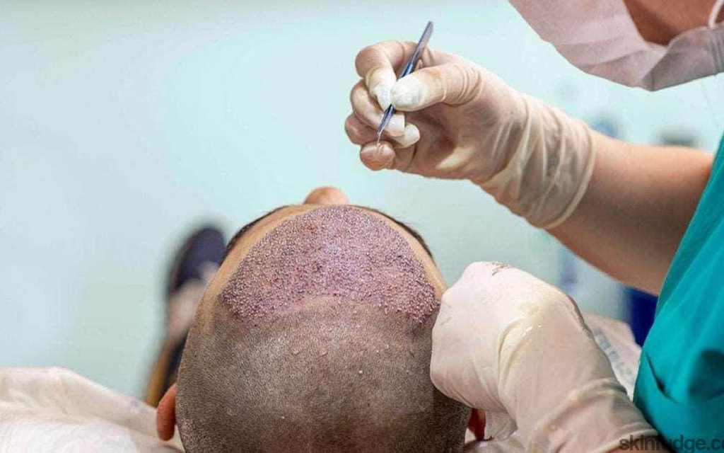 FUE Hair Transplant in Islamabad