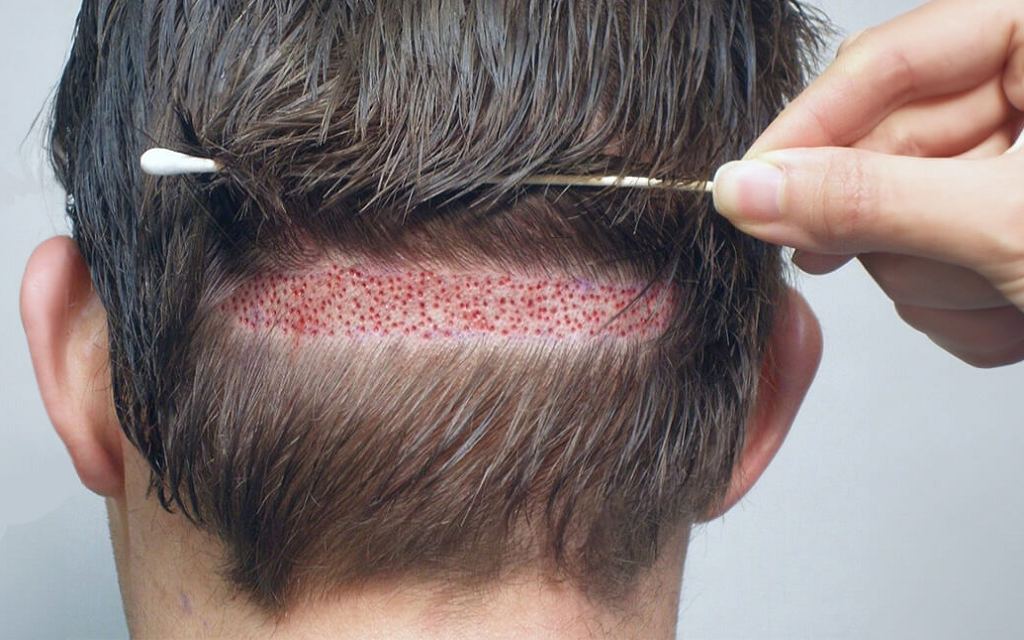 FUT Hair Transplant in Islamabad