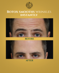 Best Botox in Islamabad