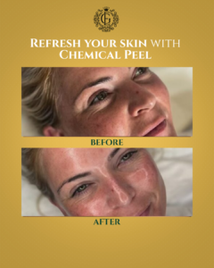 Best Chemical Peel in Islamabad