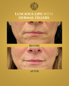 Best Dermal Fillers in Islamabad