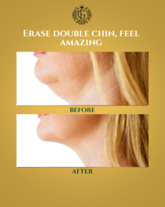Best Double Chin Removal in Islamabad