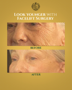 Best Face Lift in Islamabad