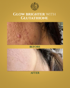 Best Glutathione Injection in Islamabad