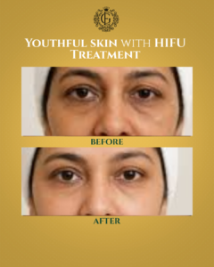 Best HIFU Treatment in Islamabad