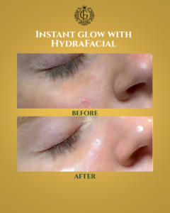 Best Hydrafacial in Islamabad