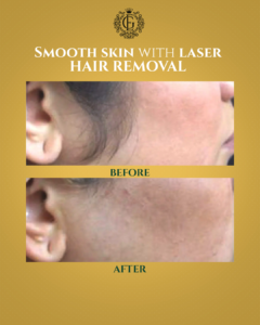 Best Laser Hair Removal in Islamabad