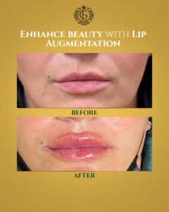 Best Lip Augmentation in Islamabad