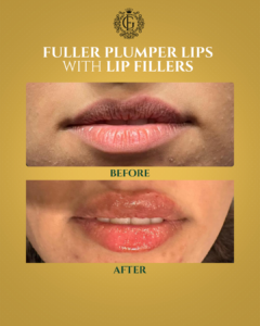 Best Lip Fillers in Islamabad