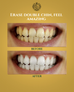 Best Teeth Whitening in Islamabad