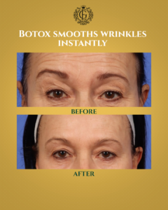 Botox Islamabad