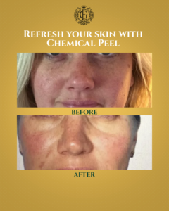 Chemical Peel Islamabad