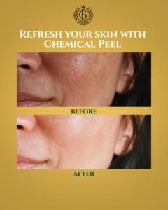 Chemical Peel in Islamabad