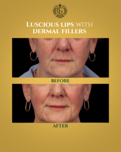 Dermal Fillers in Islamabad