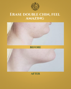 Double Chin Removal Islamabad