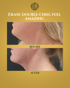 Double Chin Removal in Islamabad
