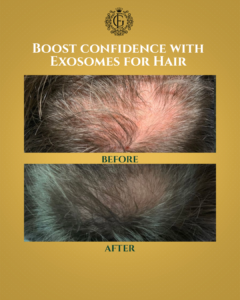 Exosomes for Hair Islamabad