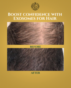 Exosomes for Hair in Islamabad