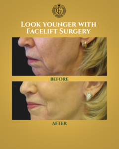 Face Lift in Islamabad