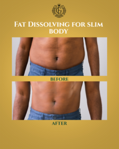 Fat Dissolving in Islamabad