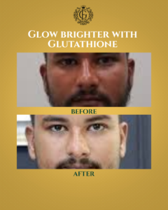 Glutathione Injection in Islamabad