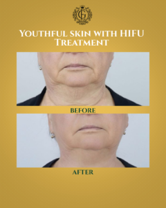 HIFU Treatment Islamabad