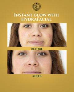 Hydrafacial Islamabad