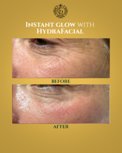 Hydrafacial in Islamabad