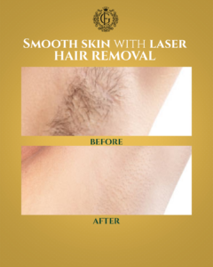 Laser Hair Removal Islamabad