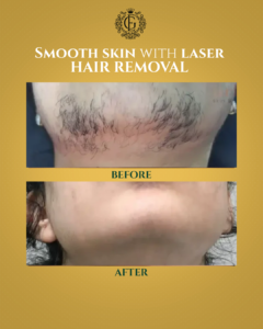 Laser Hair Removal in Islamabad