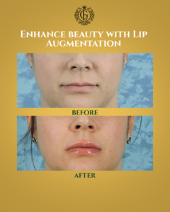 Lip Augmentation Islamabad