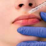 Lip Fillers Cost in Islamabad
