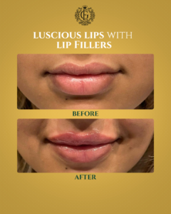 Lip Fillers Islamabad