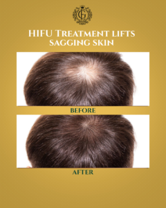 PRP Treatment in Islamabad