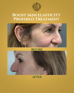 Profhilo Treatment Islamabad