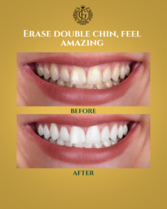 Teeth Whitening Islamabad