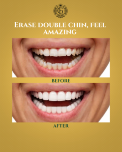 Teeth Whitening in Islamabad