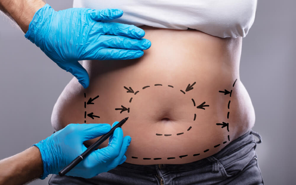 Is Liposuction a Safe Procedure
